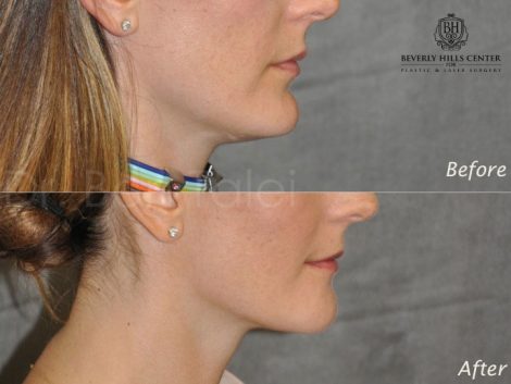 Internal Chin Reduction - Right Side