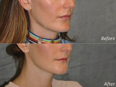 Internal Chin Reduction - Right Side