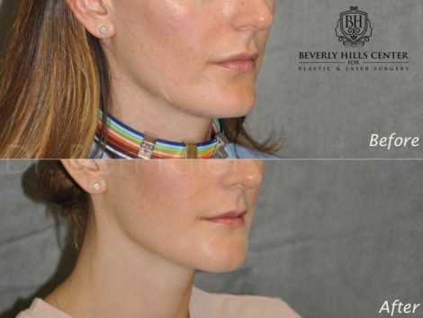 Internal Chin Reduction - Right Side