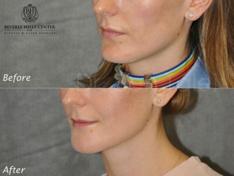 Beverly Hills Center Female Patient Before and After Internal Chin Reduction Procedure