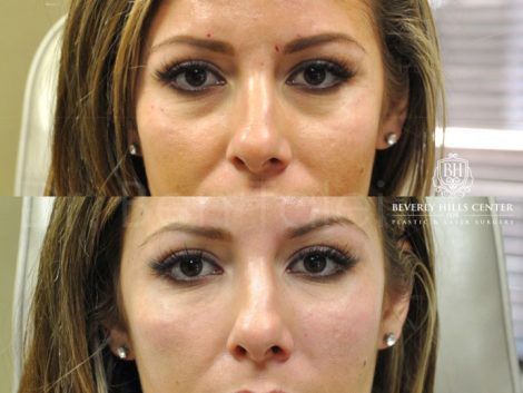 Beverly Hills Center Female Patient Before and After Non-surgical Under Eye Rejuvenation Procedure