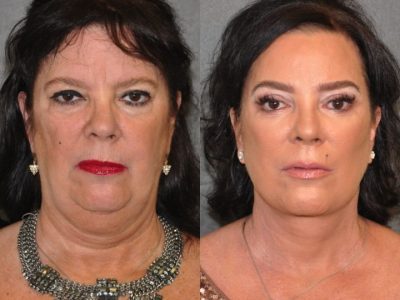 Kris Jenner’s Sister – Karen Houghton - AuraLyft with Brow & Eyelid Rejuvenation - Front