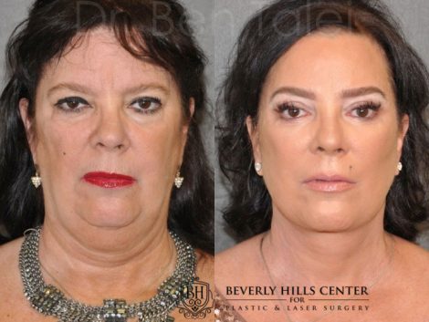 Kris Jenner’s Sister – Karen Houghton - AuraLyft with Brow & Eyelid Rejuvenation - Front
