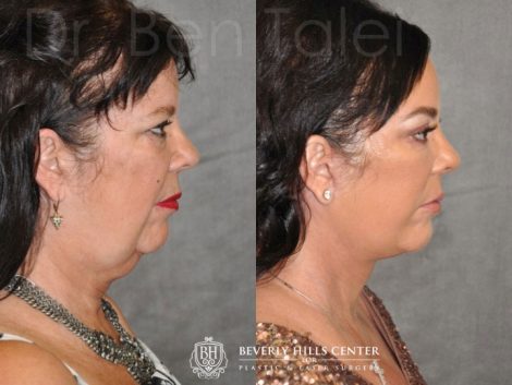 Kris Jenner’s Sister – Karen Houghton - AuraLyft with Brow & Eyelid Rejuvenation - Right Side