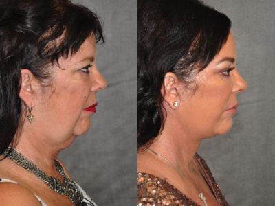 Kris Jenner’s Sister – Karen Houghton - AuraLyft with Brow & Eyelid Rejuvenation - Right Side