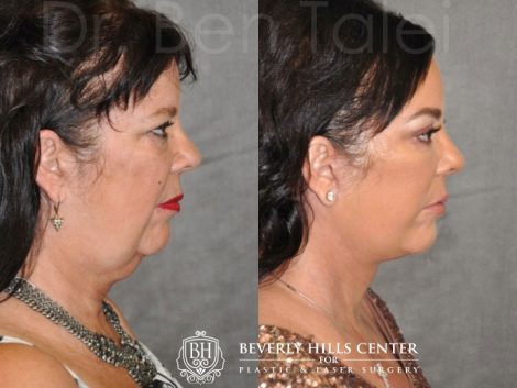 Kris Jenner’s Sister – Karen Houghton - AuraLyft with Brow & Eyelid Rejuvenation - Right Side