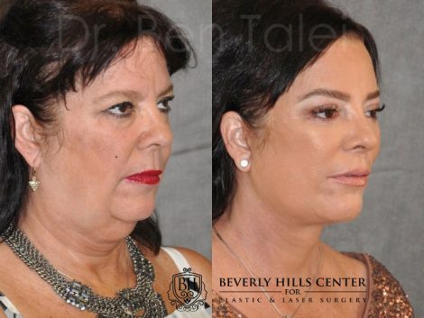 Kris Jenner’s Sister – Karen Houghton - AuraLyft with Brow & Eyelid Rejuvenation - Right Side