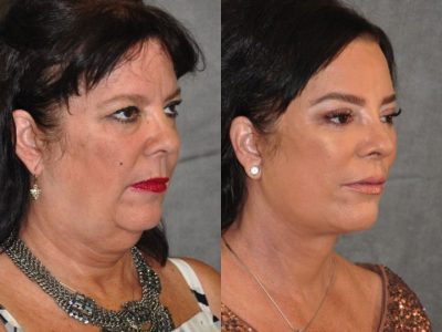 Kris Jenner’s Sister – Karen Houghton - AuraLyft with Brow & Eyelid Rejuvenation - Right Side