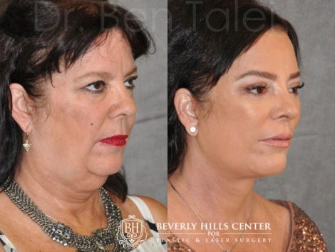 Kris Jenner’s Sister – Karen Houghton - AuraLyft with Brow & Eyelid Rejuvenation - Right Side