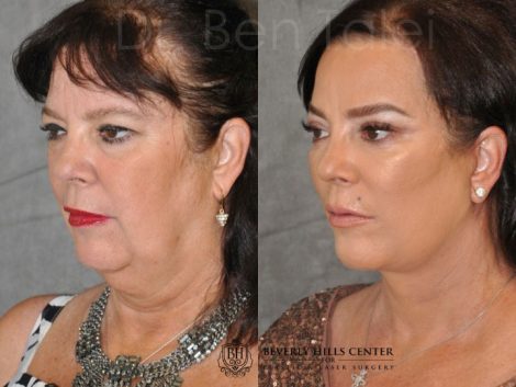Kris Jenner’s Sister – Karen Houghton - AuraLyft with Brow & Eyelid Rejuvenation - Left Side
