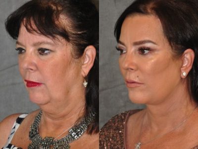 Kris Jenner’s Sister – Karen Houghton - AuraLyft with Brow & Eyelid Rejuvenation - Left Side