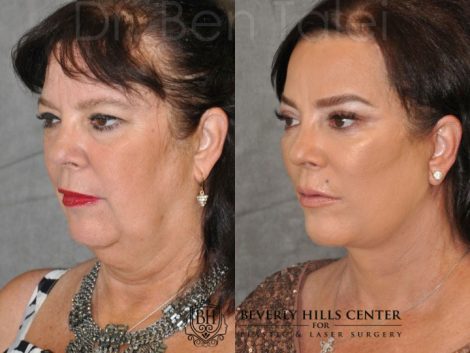 Kris Jenner’s Sister – Karen Houghton - AuraLyft with Brow & Eyelid Rejuvenation - Left Side