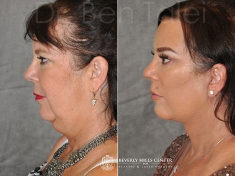 Kris Jenner’s Sister – Karen Houghton - AuraLyft with Brow & Eyelid Rejuvenation - Left Side
