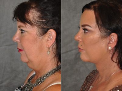 Kris Jenner’s Sister – Karen Houghton - AuraLyft with Brow & Eyelid Rejuvenation - Left Side
