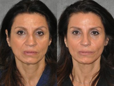Revision Reconstruction Rib Rhinoplasty - Front