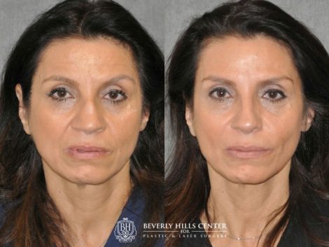 Revision Reconstruction Rib Rhinoplasty - Front