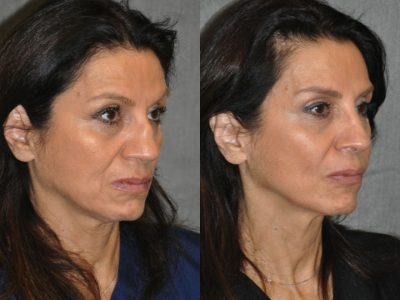Revision Reconstruction Rib Rhinoplasty - Right Side