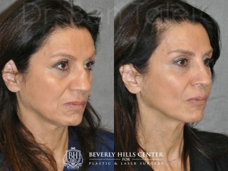 Revision Reconstruction Rib Rhinoplasty - Right Side
