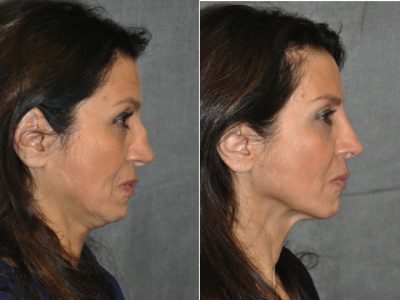 Revision Reconstruction Rib Rhinoplasty - Right Side