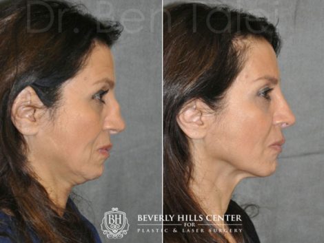Revision Reconstruction Rib Rhinoplasty - Right Side