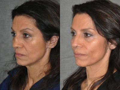 Revision Reconstruction Rib Rhinoplasty - Left Side