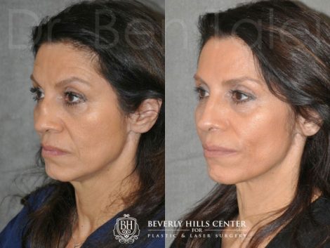 Revision Reconstruction Rib Rhinoplasty - Left Side