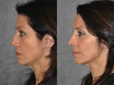 Revision Reconstruction Rib Rhinoplasty - Left Side