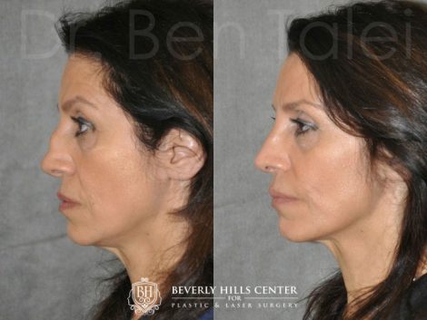 Revision Reconstruction Rib Rhinoplasty - Left Side