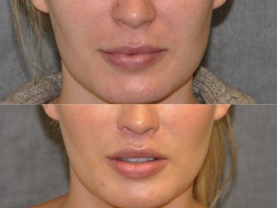Modified Upper Lip Lift for improved facial balance - Front