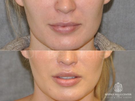 Modified Upper Lip Lift for improved facial balance - Front