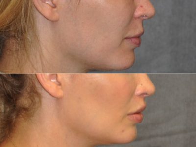 Modified Upper Lip Lift for improved facial balance - Right Side