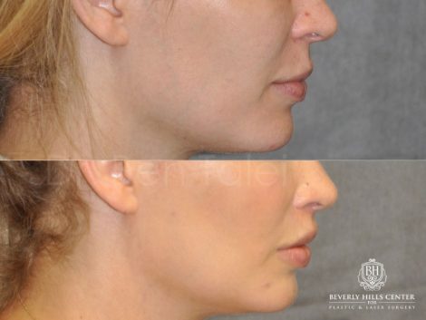 Modified Upper Lip Lift for improved facial balance - Right Side