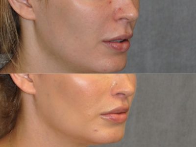 Modified Upper Lip Lift for improved facial balance - Right Side