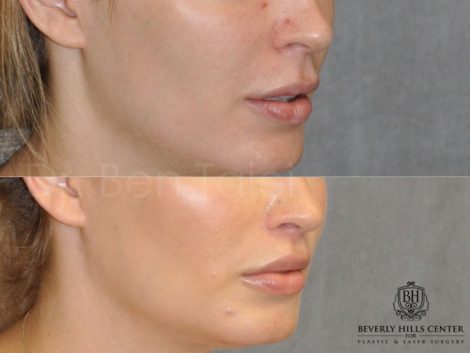 Modified Upper Lip Lift for improved facial balance - Right Side