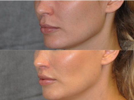 Modified Upper Lip Lift for improved facial balance - Left Side