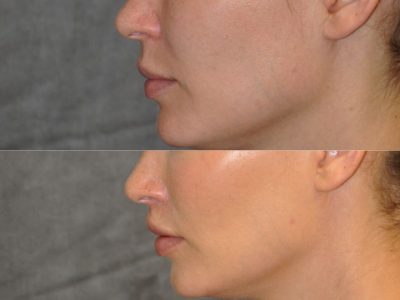 Modified Upper Lip Lift for improved facial balance - Left Side
