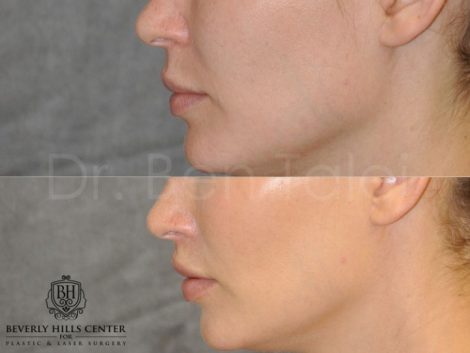 Modified Upper Lip Lift for improved facial balance - Left Side