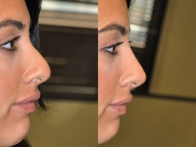 Non Surgical, Liquid Rhinoplasty / Nosejob