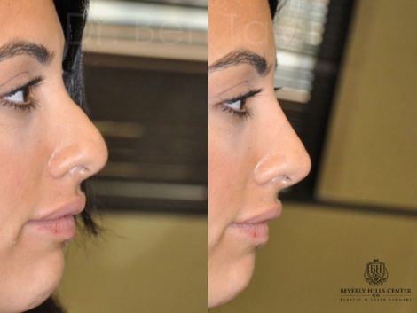 Non Surgical, Liquid Rhinoplasty / Nosejob