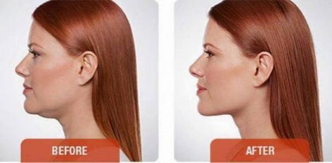 Beverly Hills Center Female Patient Before and After Chin Kybella Injections Treatment