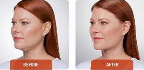 Beverly Hills Center Female Patient Before and After Chin Kybella Injections Treatment