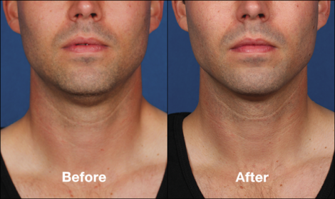 Beverly Hills Center Male Patient Before and After Chin Kybella Injections Treatment