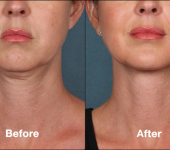 Beverly Hills Center Female Patient Before and After Chin Kybella Injections Treatment