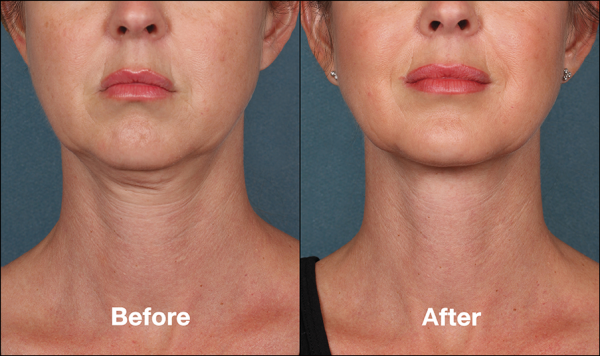 Beverly Hills Center Female Patient Before and After Chin Kybella Injections Treatment
