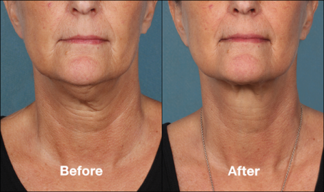 Beverly Hills Center Female Patient Before and After Chin Kybella Injections Treatment
