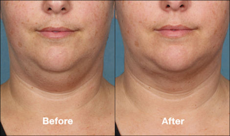 Beverly Hills Center Female Patient Before and After Chin Kybella Injections Treatment
