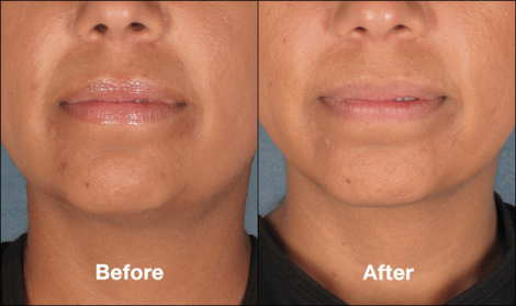 Beverly Hills Center Patient Before and After Chin Kybella Injections Treatment