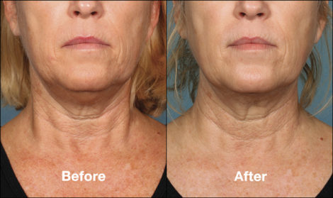 Beverly Hills Center Female Patient Before and After Chin Kybella Injections Treatment