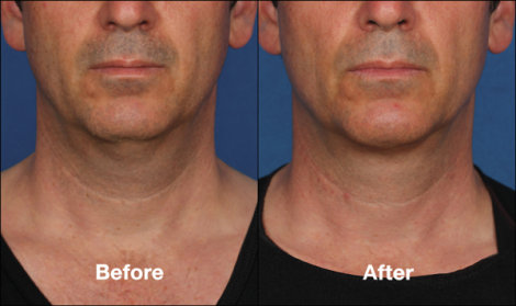 Beverly Hills Center Male Patient Before and After Chin Kybella Injections Treatment