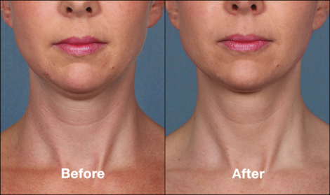 Beverly Hills Center Female Patient Before and After Chin Kybella Injections Treatment